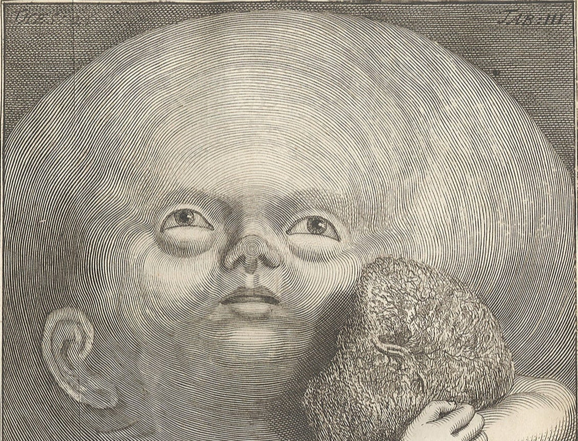 Hydrocephalus Theasurus Anatomicus & Thesaurus Animalium by Fredrik Ruysch (1638-1731) - postcard