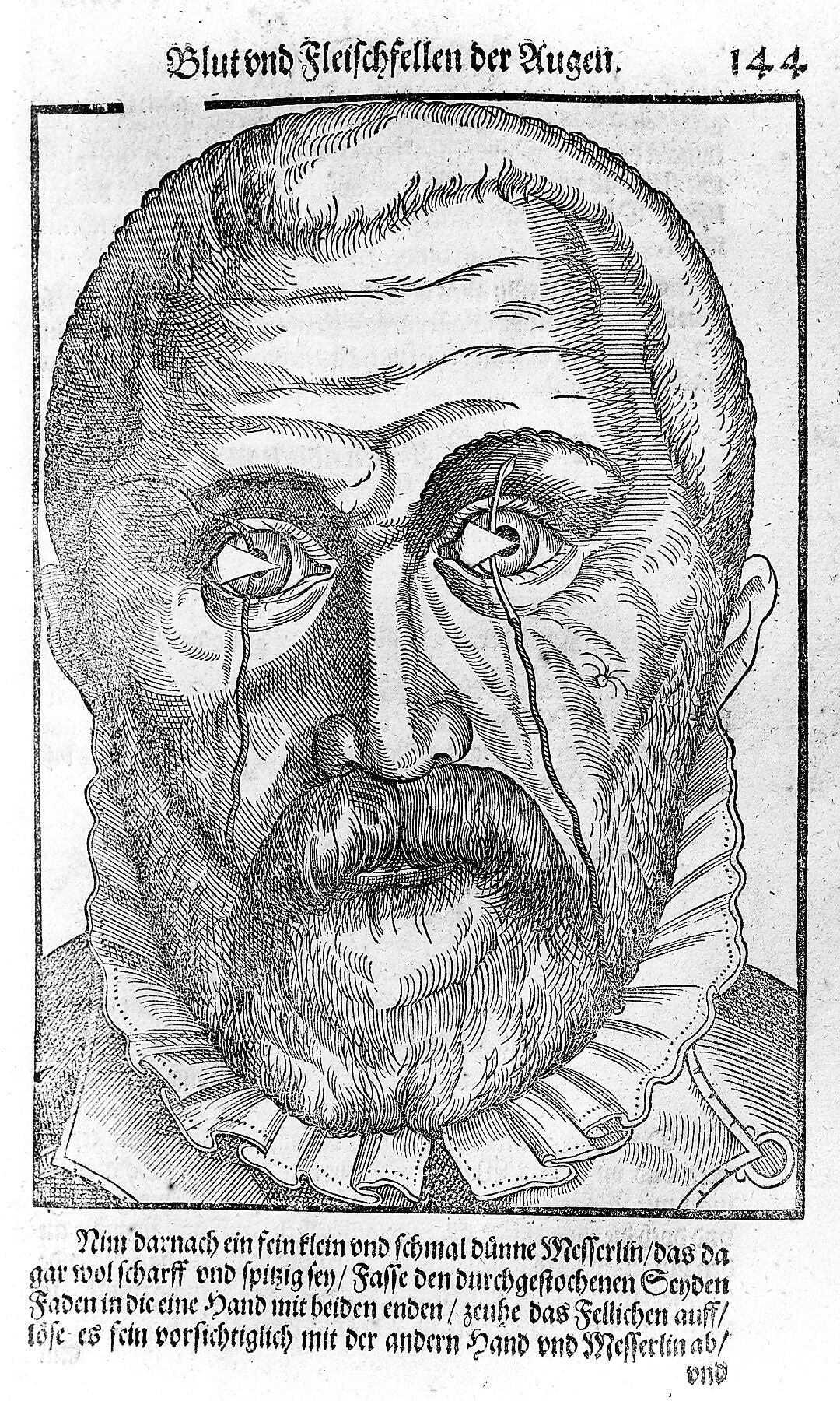 Ophtalmodoulée de Georg Bartisch - 1583