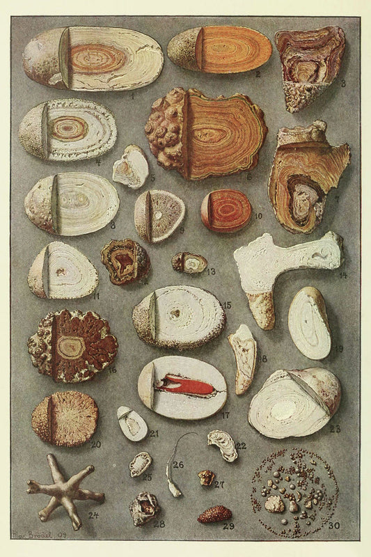 Kidney and Bladder Stones by Max Brödel - 1909