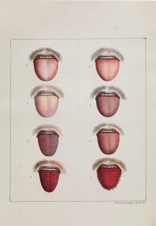 Different Stages of Yellow Fever by Etienne Pariset & Andre Mazet, 1820 - Postcard Classic Postcard Media 3 of 3