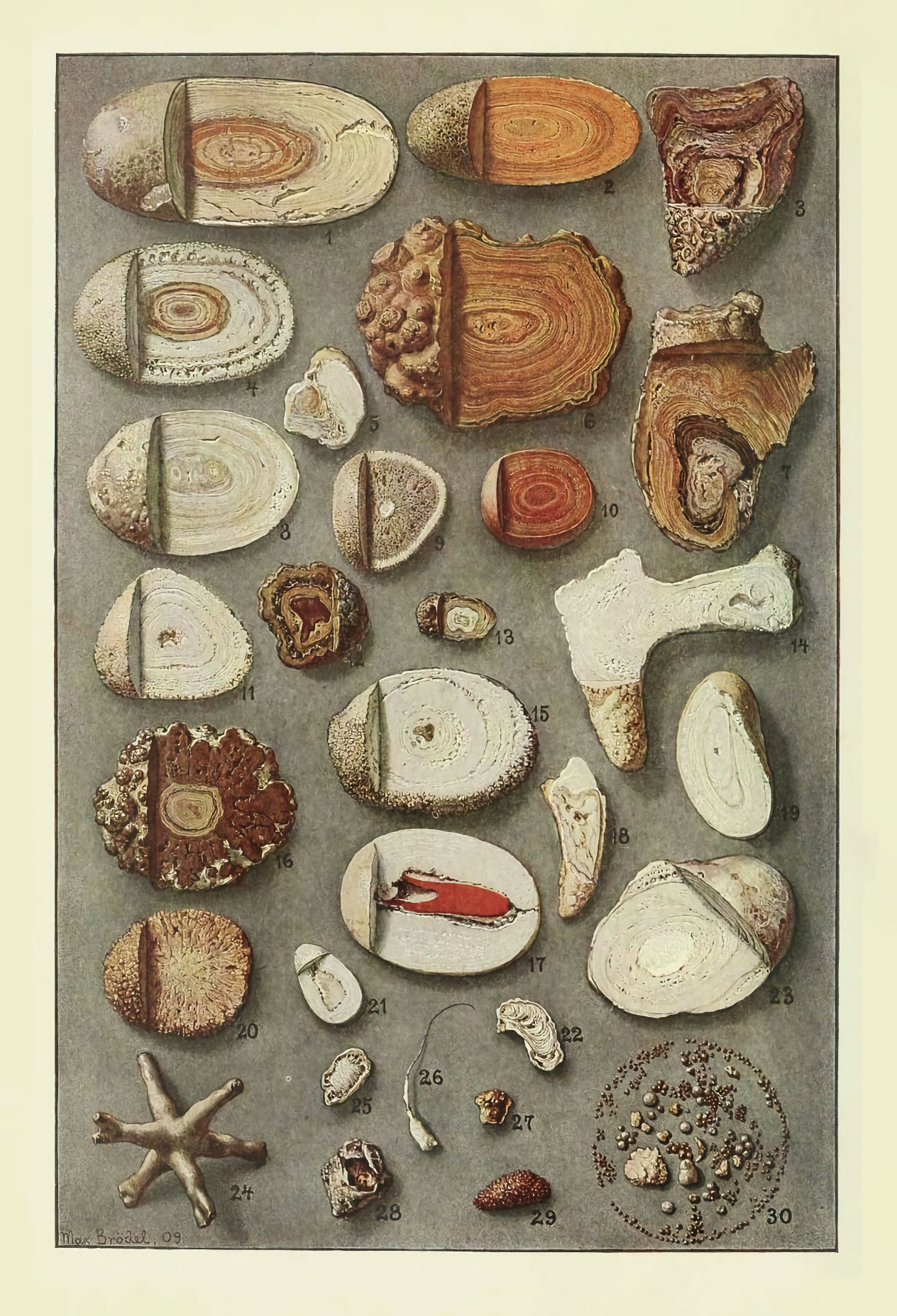 Calculs rénaux et vésicaux de Max Brödel, 1909 - Carte postale
