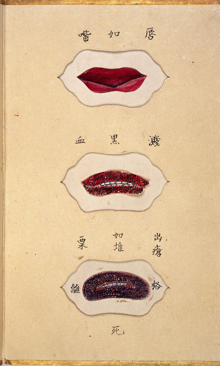 Discoloration of the lips from Smallpox by Ikeda Zuisen