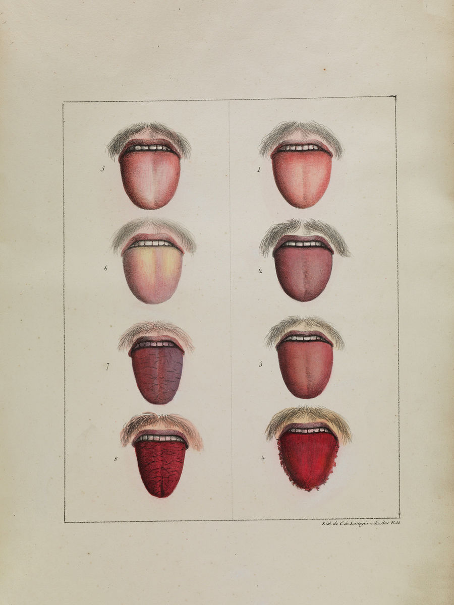 Diferentes etapas de la fiebre amarilla 